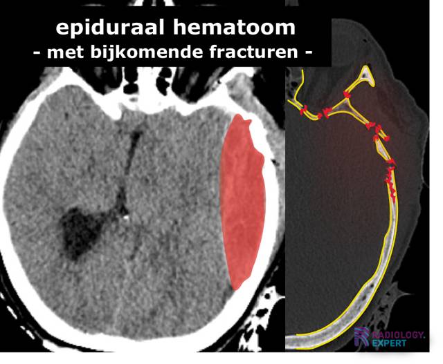 CT hersenen bloeding
